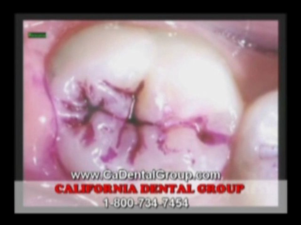 Dental hygiene | Cavity Prevention | Dr. Sahabi  Los Angeles