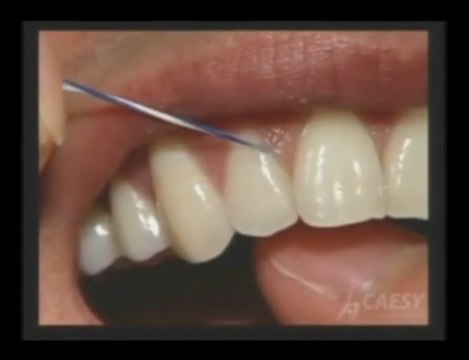 Dentist Glendale|Dental floss|Dentist Burbank | Dr. Sahabi