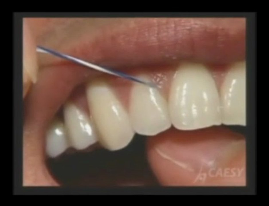 Dentist  Glendale|Dental floss|Dentist Burbank | Dr. Sahabi