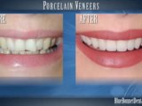Porcelain Veneers – Cosmetic Dentistry in Lafayette, LA