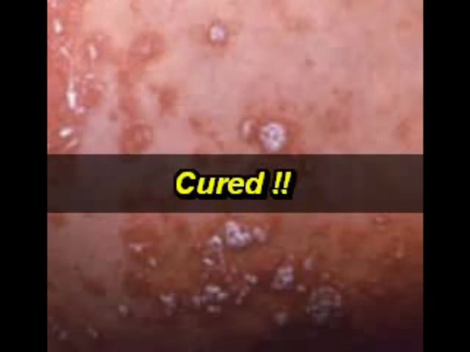 Home cure yeast How To Treat Yeast Infections In Women - Fin