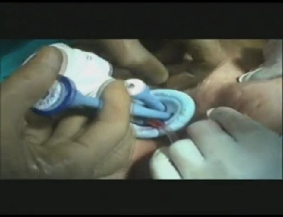 Single Incision Laparoscopic Surgery Video