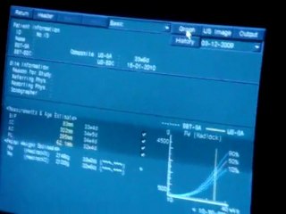 echographie 34eme semaine faite le 3decembre 2009