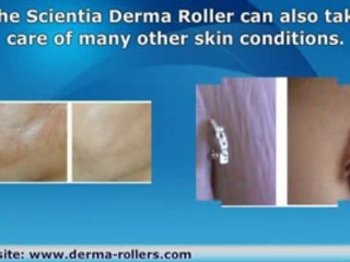 Chicken Pox Scar Removal