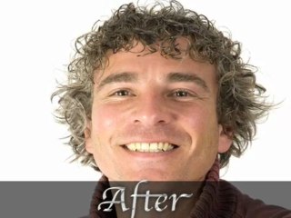 Hair Replacement System