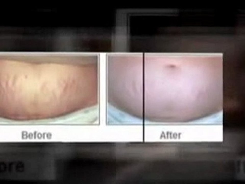 insane stretch marks on  stomach can i ever get rid of them?