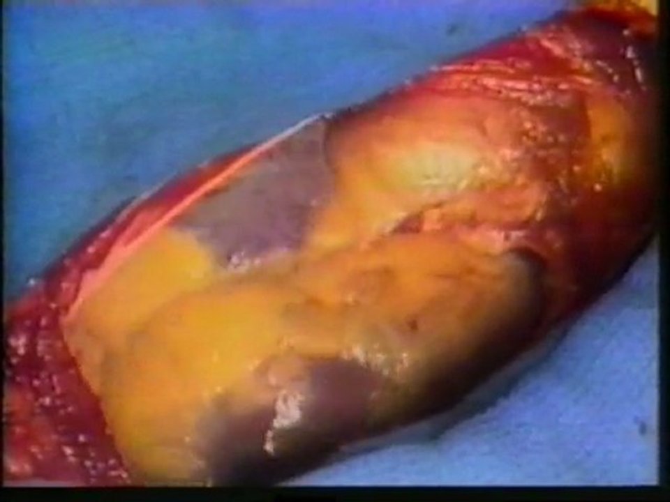 Atherosclerosis Surgery & results of McDonalds in the Blood