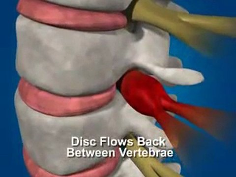 Atlanta Disc Herniation/Bulge Relief - Chiropractor Atlanta