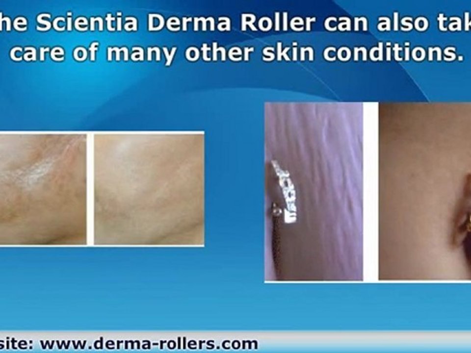 Atrophic Scar Removal