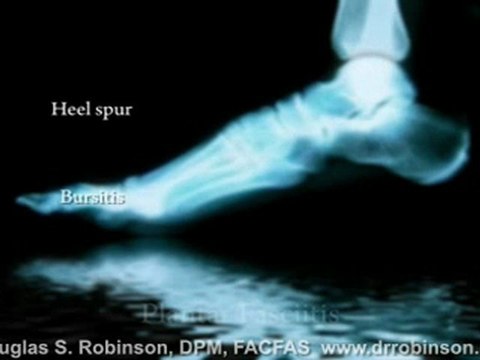 Plantar Fasciitis Campbell, CA