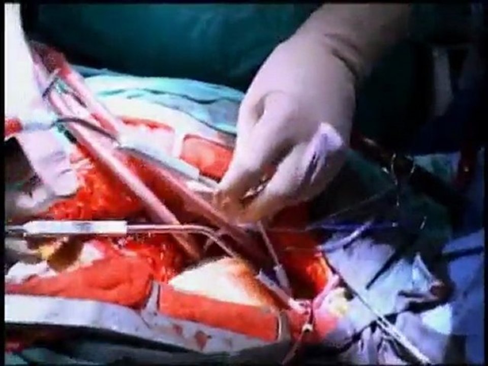 Part 3: The final part of Debbie's heart transplant story
