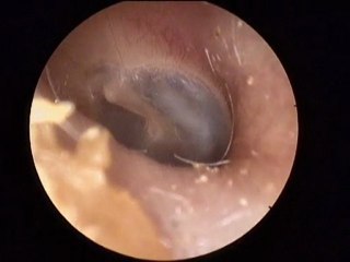 Oreille gauche, tympan, conduit auditif externe, Valsalva