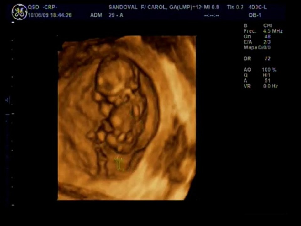 ECHOGRAPHIE