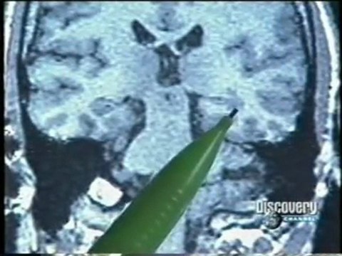 Hipocampo y estres postraumatico (TEPT)