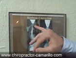 Chiropractor Camarillo,CA,93010,Free Consultation