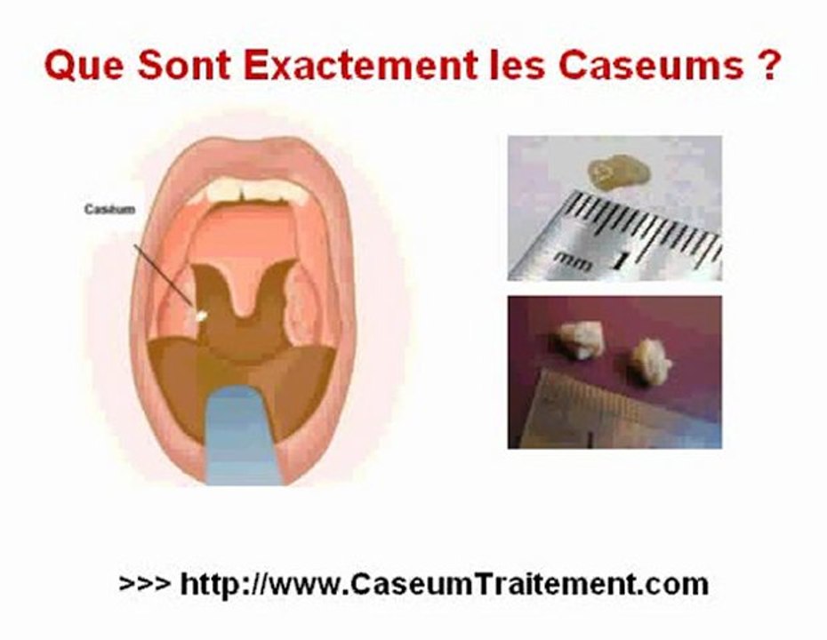 Caseum Amygdale - Caseum Amygdales