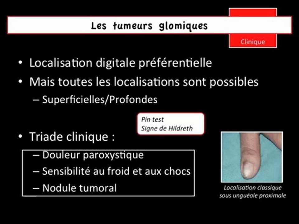 Une tumeur du doigt