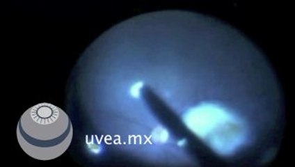 Faco Vitrectomia en panuveitis por toxoplasma