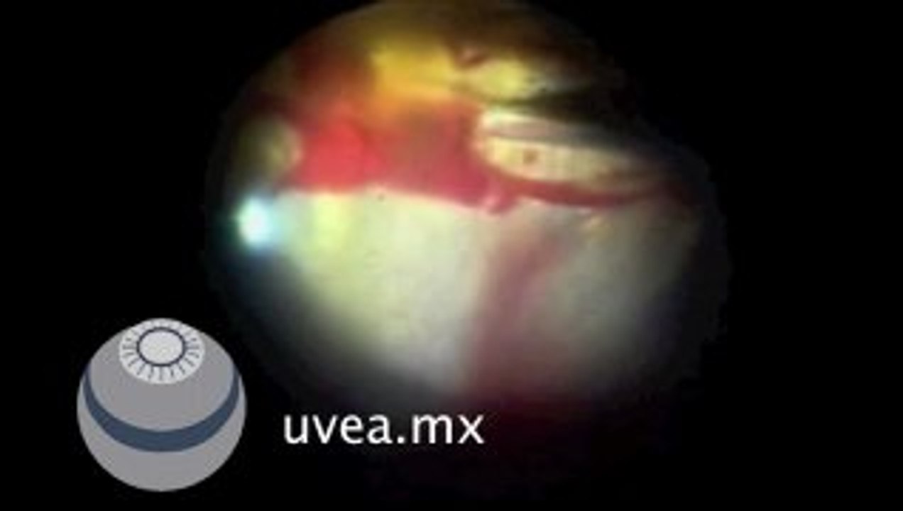 Vitrectomia posterior en Pars Planitis