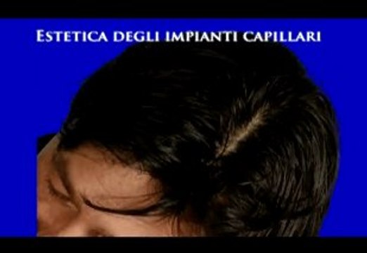 IMPIANTI CAPILLARI PER UOMO E DONNA luigiuomo.com