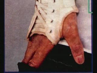 michael jackson vitiligo