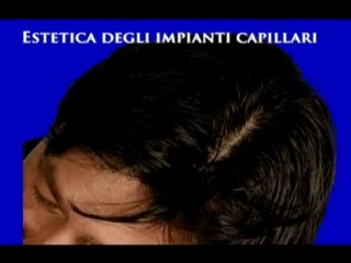 TRAPIANTO DI CAPELLI DONNA www.luigiuomo.com