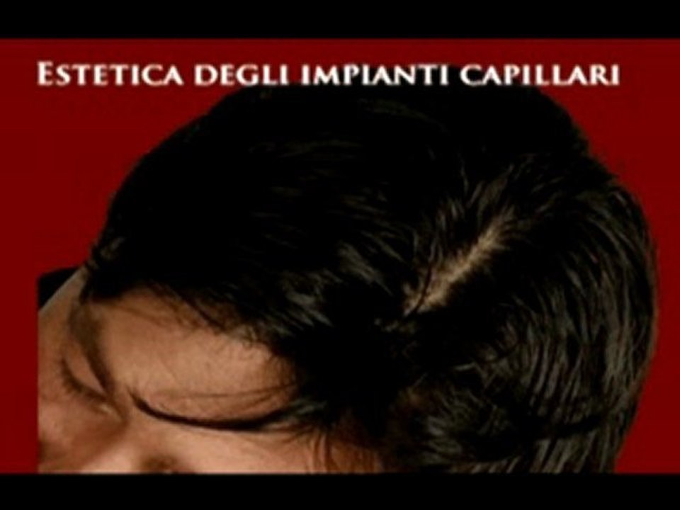 BLOG CALVIZIE www.luigiuomo.com