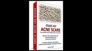 Acne Scar Removal - Why You Must Read ERASE MY ACNE SCARS