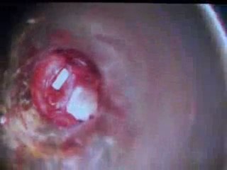 Dr Abdelilah Mhidi l'intervention  otospongiose  a oujda