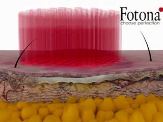 FOTONA - Estrías con láser - Animación 3D