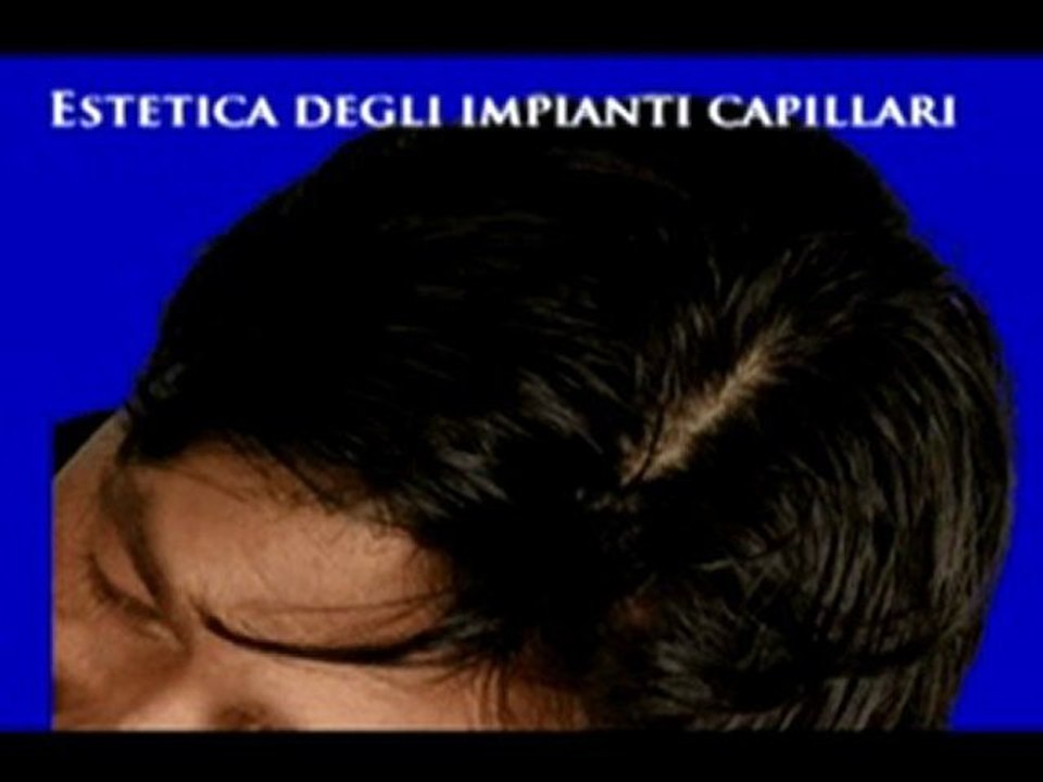 TRAPIANTI DEI CAPELLI www.luigiuomo.com
