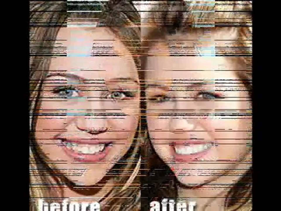 How to Get Celebrity Smile – Using teeth whitening pen