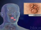 Herpes (v.o. ingles)