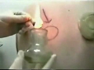 explication d une seance de hijama