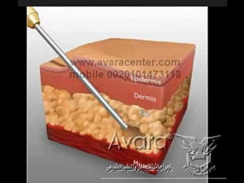 تصغير الارداف و تصغير المؤخرة شفط الارداف و شد المؤخرة