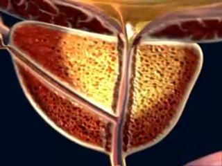 Cancer de prostata (v.o. ingles)