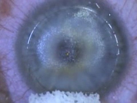 Opération myopie lasik tout laser 2010 Docteur Marc Timsit