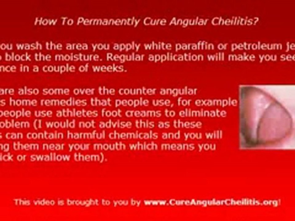 How to cure Angular Cheilitis