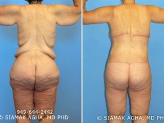 High Definition Total Body Lift by Dr. Agha