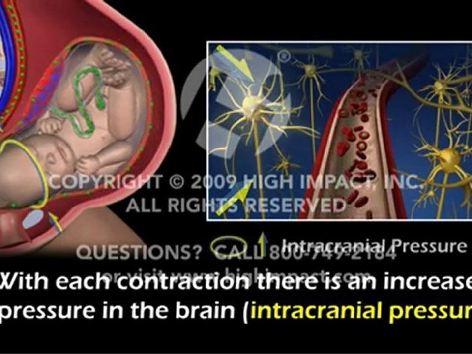 Contraction Effects