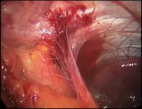 Learn More About Laparoscopic Adjustable Banding Options
