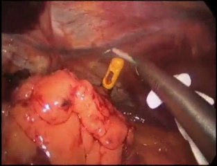 Download Video: Better Health with Laparoscopic Adjustable Banding Surgeries