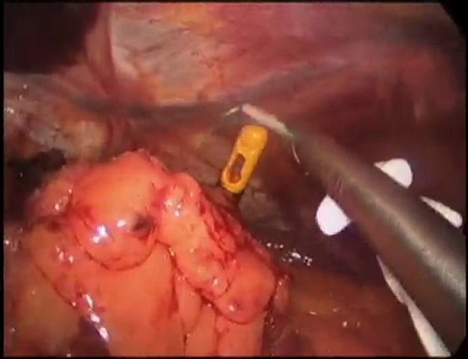 Better Health with Laparoscopic Adjustable Banding Surgeries