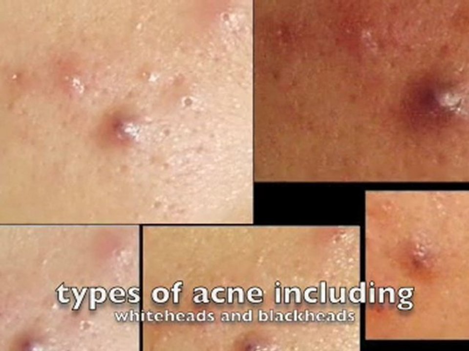Natural acne treatment Buying Tips For Dog Toys Posted By: L