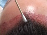 Female Hairline Lowering:  A Close-Up View of Design