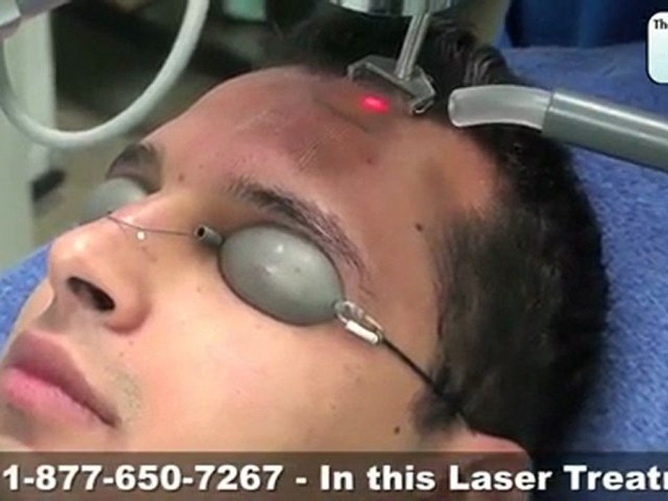FX Laser Treatment