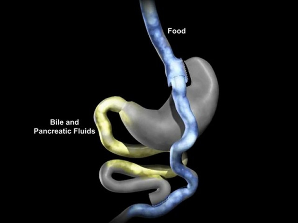 Learn More About the Gastric Bypass San Antonio Has for You