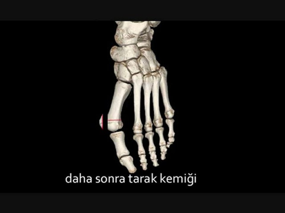 Halluks Valgus
