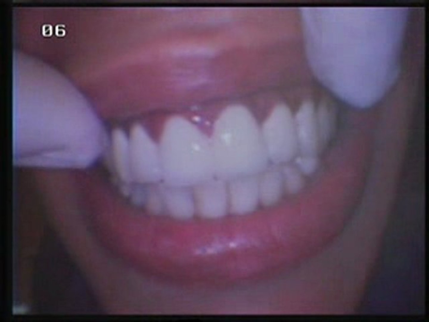 Prothese Fixe Sur Implants  : Entretien Facilité Par Le Fait De.