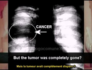 2-Dr Simoncini, Cancer, l'hypothèse fongique (VO stfr)